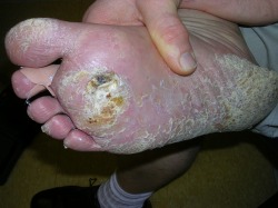 How diabetes affects feet - keepmyfeet.weebly.com